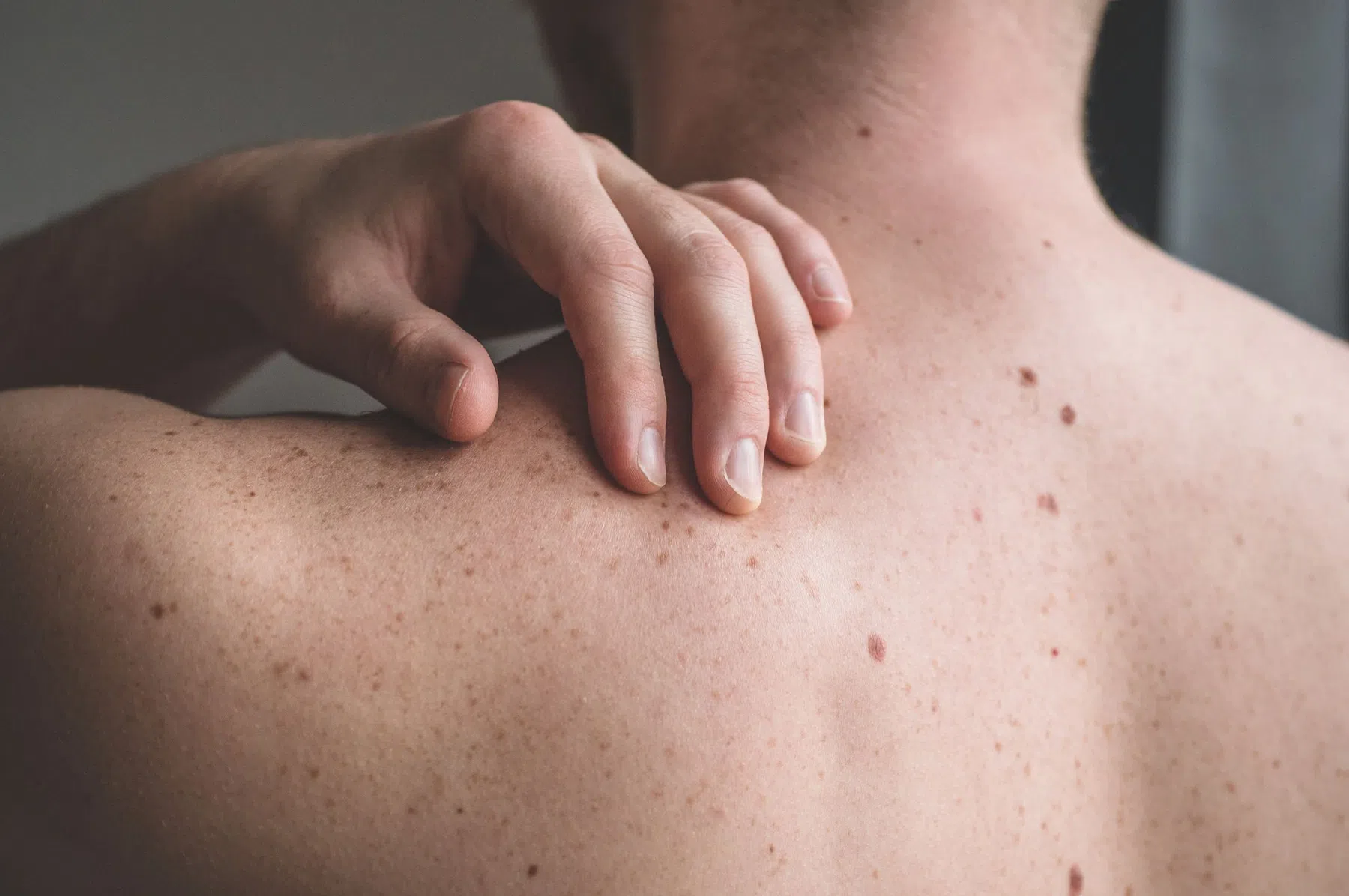 Acne op rug