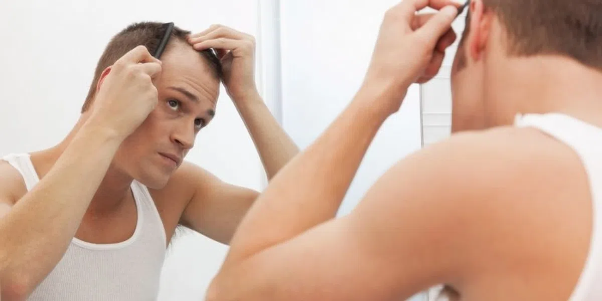 Dit moet je weten over kaal worden