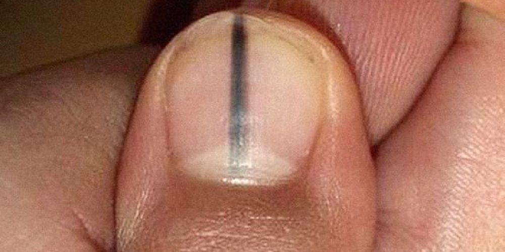 Waarom-je-een-zwarte-plek-op-je-nagels-nooit-moet-negeren.jpg