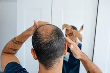 Thumbnail for article: Werkt biotine tegen dunner wordend haar of haaruitval?