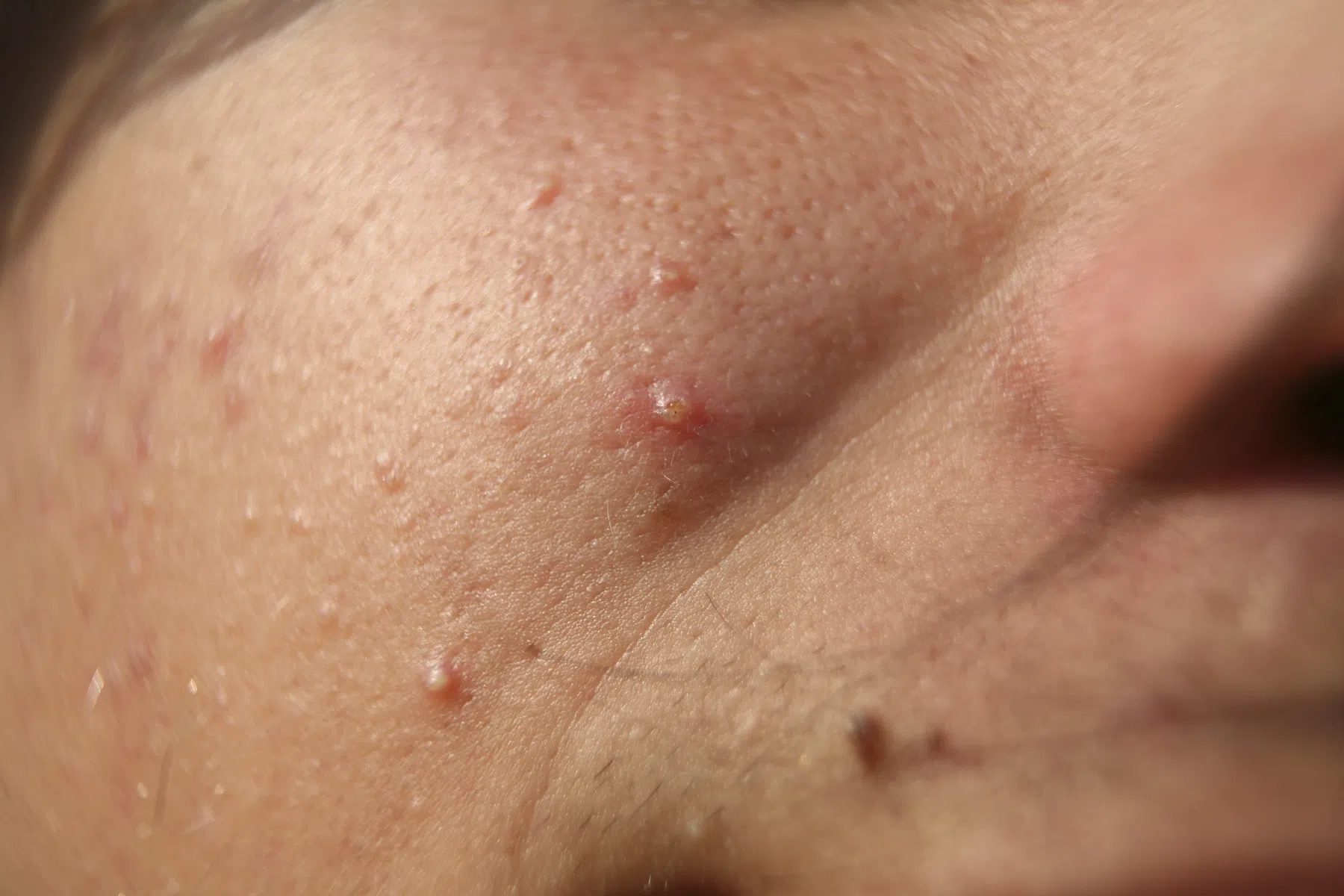 Last van acne? Probeer deze 6 tips eens