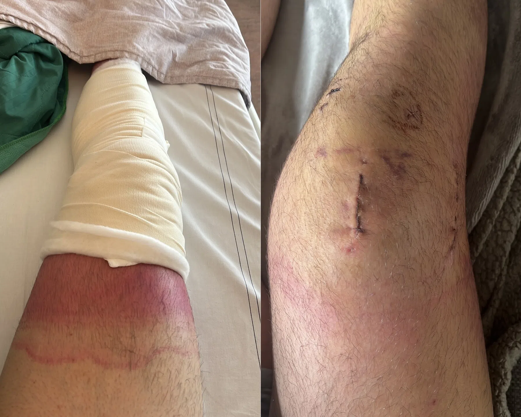 Zo herstelde ik van mijn kruisband- en meniscusoperatie (deel 2)